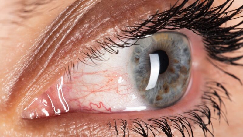 Tipos de enfermedades de los Ojos en Personas Adultas